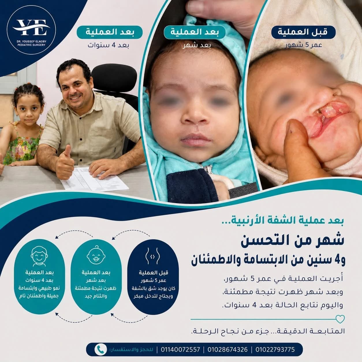 بعد عملية الشفة الأرنبية: شهر من التحسن و٤ سنوات من الابتسامة — صور الحالة قبل العملية في عمر ٥ أشهر، وبعدها بشهر، وبعد ٤ سنوات مع أ.د. يوسف النوبي